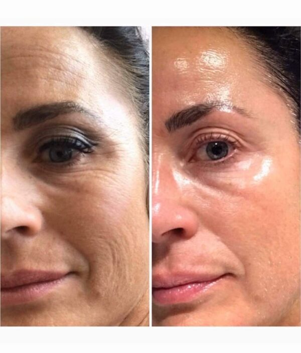 Facelift Collagen Plaster